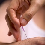 Partners 1 Acupuncture